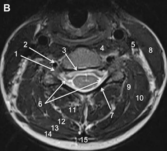MRI 下脊椎基本解剖集锦——颈椎 MRI 下脊椎基本解剖集锦——颈椎