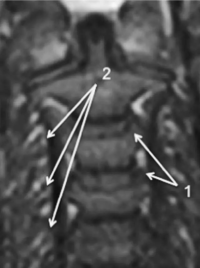 MRI 下脊椎基本解剖集锦——颈椎 MRI 下脊椎基本解剖集锦——颈椎