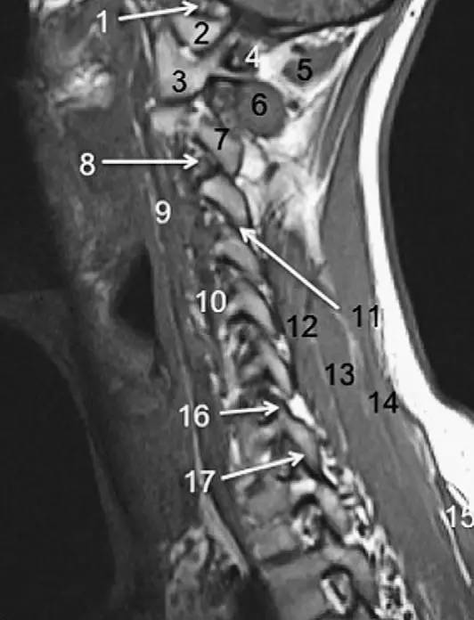 MRI 下脊椎基本解剖集锦——颈椎 MRI 下脊椎基本解剖集锦——颈椎