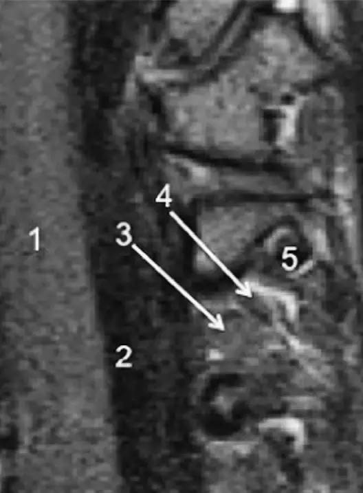 MRI 下脊椎基本解剖集锦——颈椎 MRI 下脊椎基本解剖集锦——颈椎