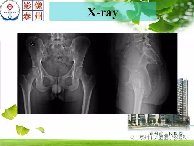 【病例】脊索瘤2例影像诊断与鉴别诊断
