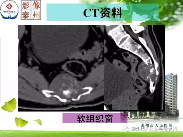 【病例】脊索瘤2例影像诊断与鉴别诊断