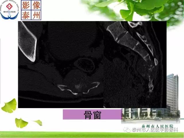 【病例】脊索瘤2例影像诊断与鉴别诊断