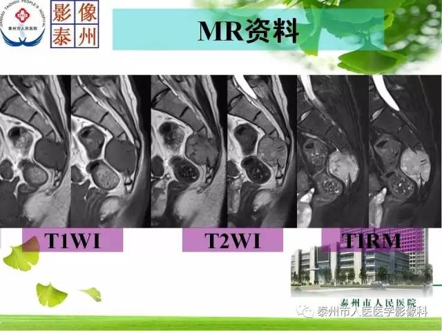 【病例】脊索瘤2例影像诊断与鉴别诊断