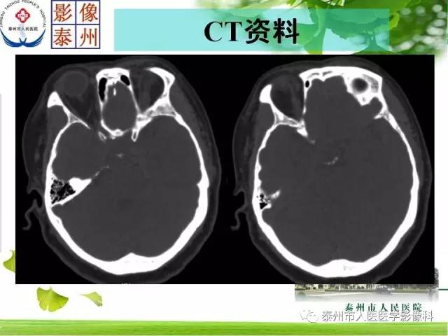 【病例】脊索瘤2例影像诊断与鉴别诊断