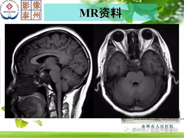 【病例】脊索瘤2例影像诊断与鉴别诊断