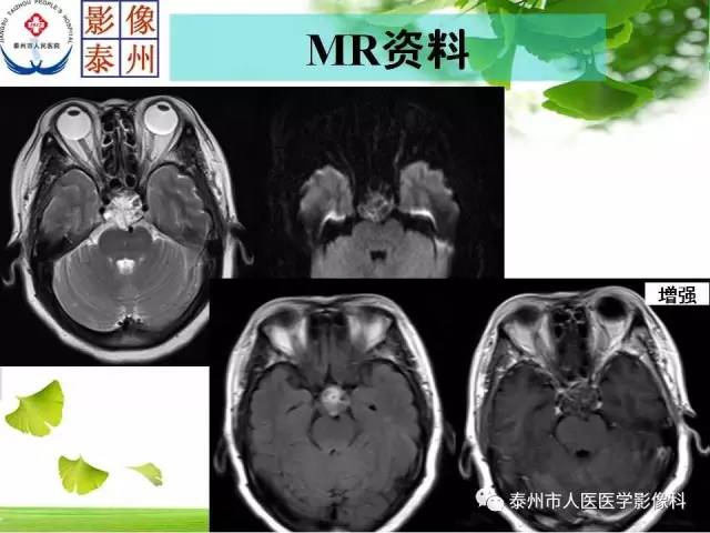 【病例】脊索瘤2例影像诊断与鉴别诊断