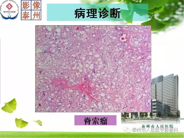 【病例】脊索瘤2例影像诊断与鉴别诊断
