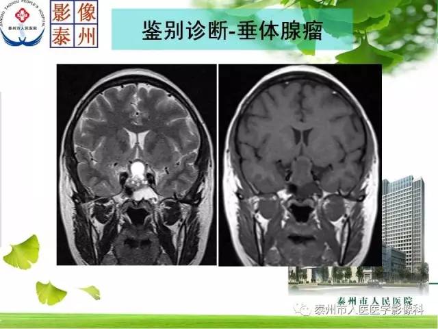【病例】脊索瘤2例影像诊断与鉴别诊断