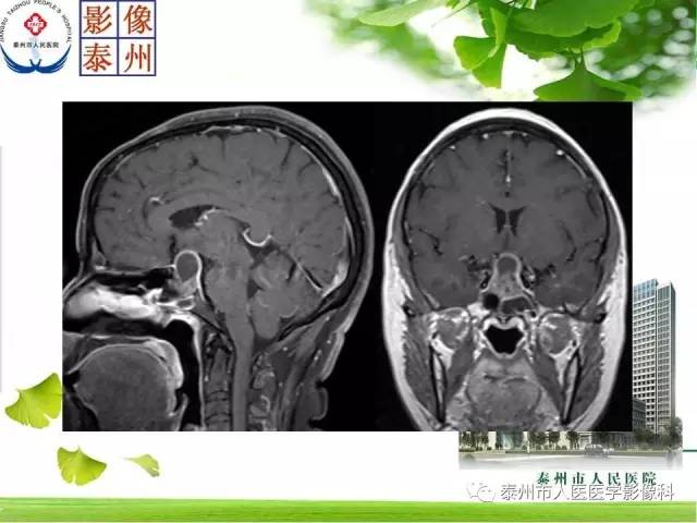 【病例】脊索瘤2例影像诊断与鉴别诊断