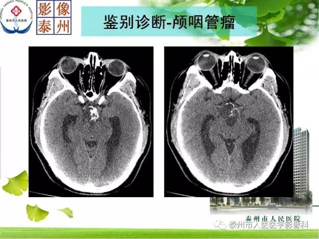 【病例】脊索瘤2例影像诊断与鉴别诊断