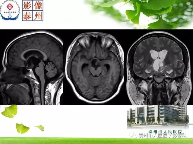 【病例】脊索瘤2例影像诊断与鉴别诊断