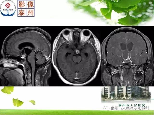 【病例】脊索瘤2例影像诊断与鉴别诊断