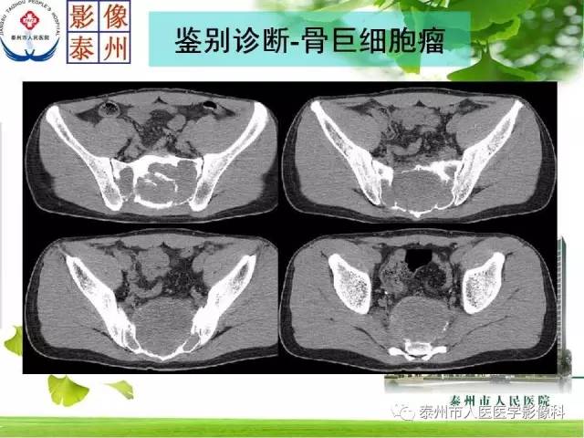 【病例】脊索瘤2例影像诊断与鉴别诊断
