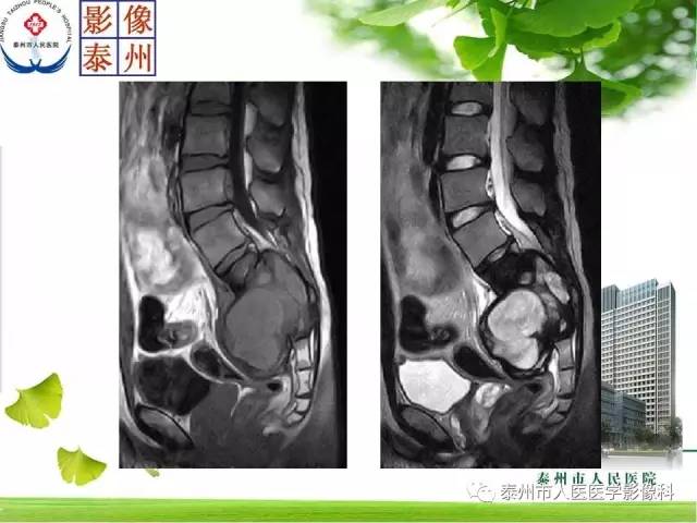 【病例】脊索瘤2例影像诊断与鉴别诊断