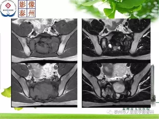 【病例】脊索瘤2例影像诊断与鉴别诊断