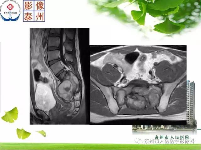 【病例】脊索瘤2例影像诊断与鉴别诊断