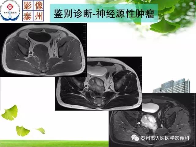 【病例】脊索瘤2例影像诊断与鉴别诊断