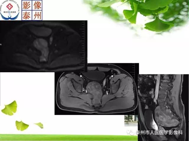【病例】脊索瘤2例影像诊断与鉴别诊断