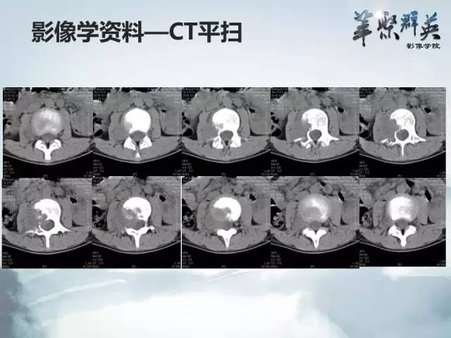 【病例】恶性蝾螈瘤1例CT及MR影像表现