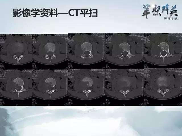 【病例】恶性蝾螈瘤1例CT及MR影像表现
