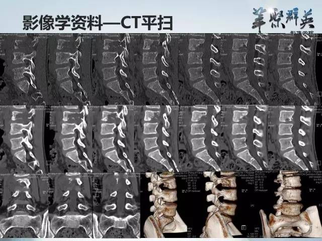 【病例】恶性蝾螈瘤1例CT及MR影像表现