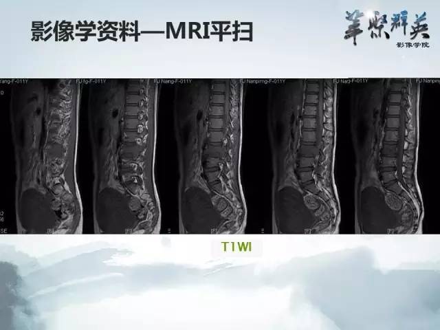【病例】恶性蝾螈瘤1例CT及MR影像表现