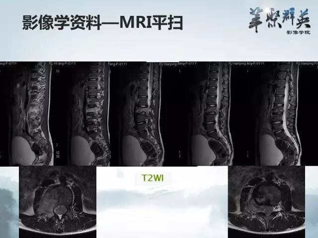 【病例】恶性蝾螈瘤1例CT及MR影像表现
