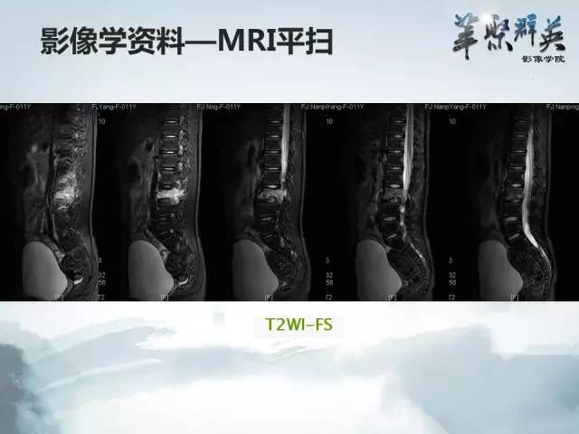 【病例】恶性蝾螈瘤1例CT及MR影像表现