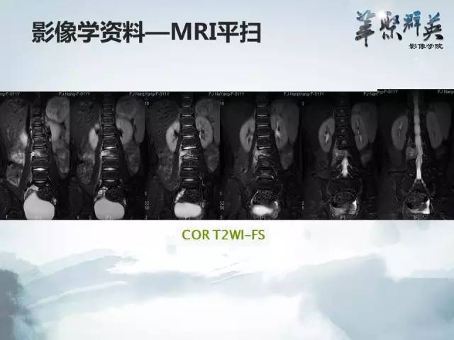 【病例】恶性蝾螈瘤1例CT及MR影像表现