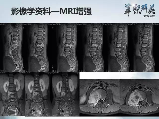 【病例】恶性蝾螈瘤1例CT及MR影像表现
