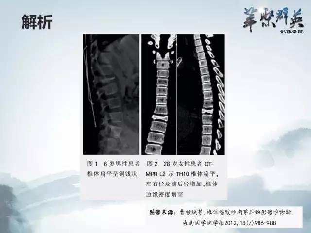 【病例】恶性蝾螈瘤1例CT及MR影像表现