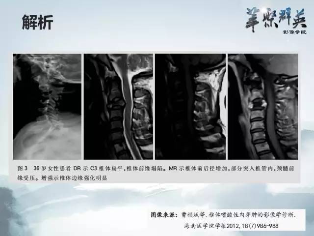 【病例】恶性蝾螈瘤1例CT及MR影像表现