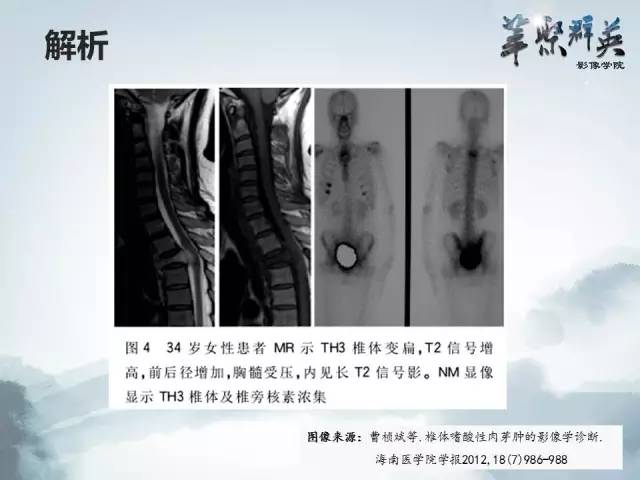 【病例】恶性蝾螈瘤1例CT及MR影像表现