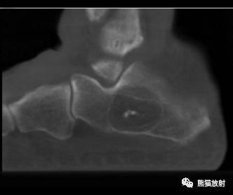 【双语病例】跟骨骨内脂肪瘤1例CT影像表现