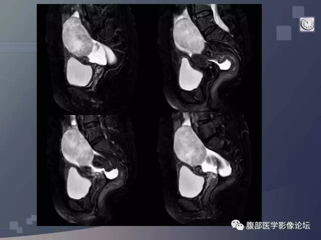 【病例】卵巢纤维卵泡膜瘤1例MR 【病例】卵巢纤维卵泡膜瘤1例MR