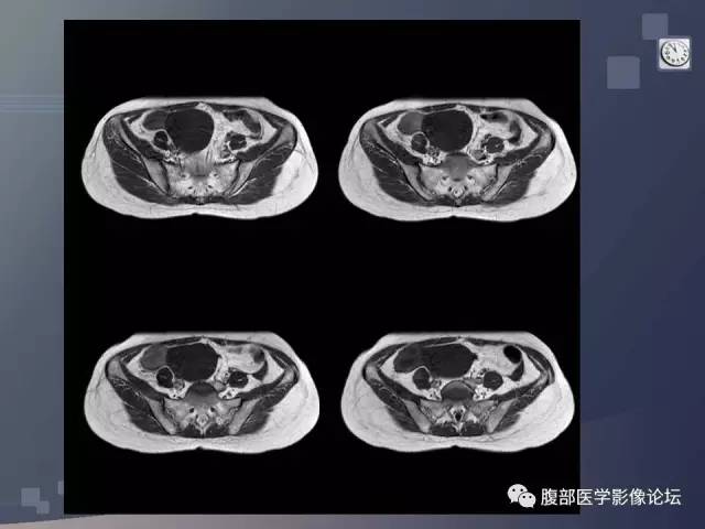 【病例】卵巢纤维卵泡膜瘤1例MR 【病例】卵巢纤维卵泡膜瘤1例MR