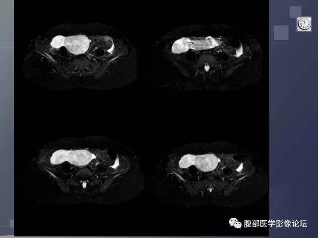 【病例】卵巢纤维卵泡膜瘤1例MR 【病例】卵巢纤维卵泡膜瘤1例MR