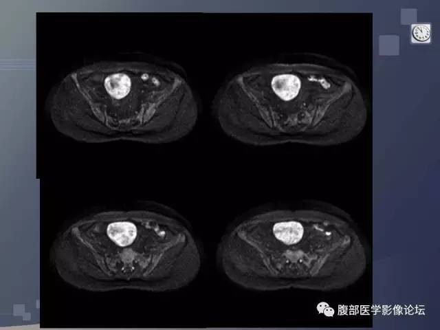 【病例】卵巢纤维卵泡膜瘤1例MR 【病例】卵巢纤维卵泡膜瘤1例MR