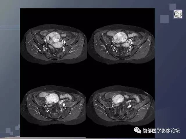 【病例】卵巢纤维卵泡膜瘤1例MR 【病例】卵巢纤维卵泡膜瘤1例MR