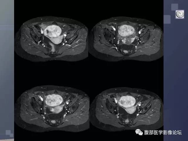 【病例】卵巢纤维卵泡膜瘤1例MR 【病例】卵巢纤维卵泡膜瘤1例MR