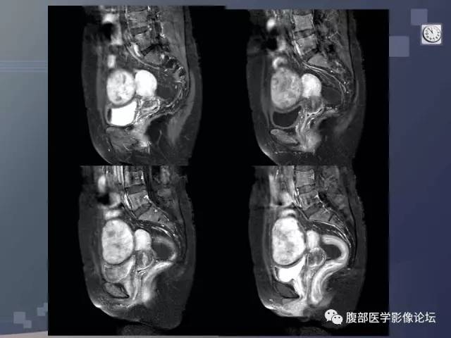【病例】卵巢纤维卵泡膜瘤1例MR 【病例】卵巢纤维卵泡膜瘤1例MR