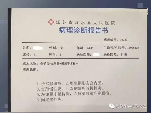 【病例】卵巢纤维卵泡膜瘤1例MR 【病例】卵巢纤维卵泡膜瘤1例MR
