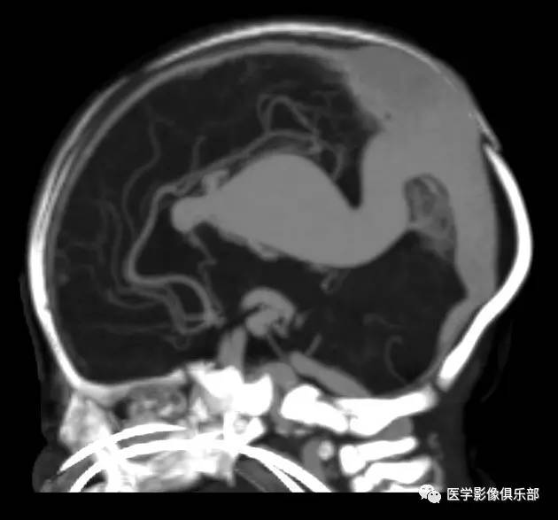 大脑大静脉畸形——Galen静脉瘤