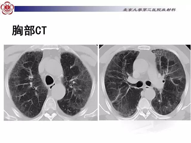 【病例】特发性间质性肺炎2例影像表现