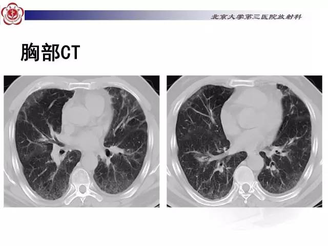 【病例】特发性间质性肺炎2例影像表现