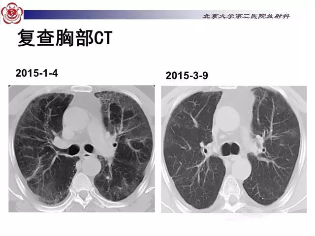 【病例】特发性间质性肺炎2例影像表现