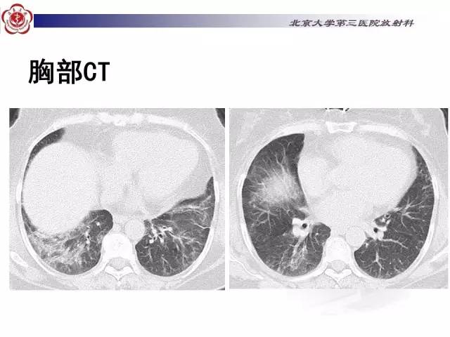 【病例】特发性间质性肺炎2例影像表现