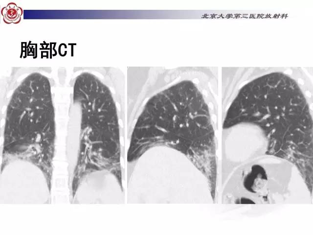 【病例】特发性间质性肺炎2例影像表现