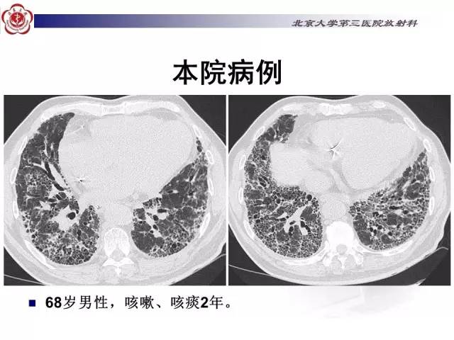 【病例】特发性间质性肺炎2例影像表现